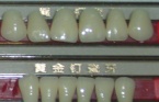 Golden Nail porcelain teeth