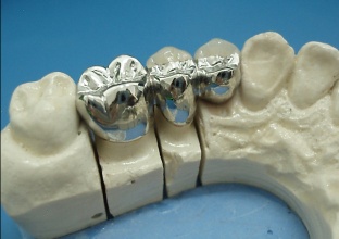 dental porcelain fused to metal crown