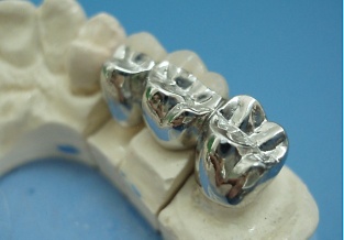 dental porcelain fused to metal crown